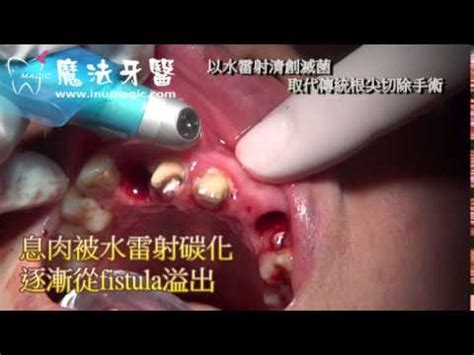 牙齒 清 創 手術